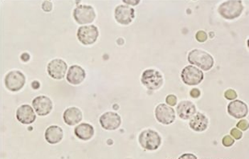 山东国康尿液分析仪解析尿液中白细胞的临床意义