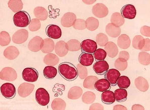 白血病患者的嗜碱性粒细胞增高显示图