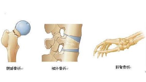 便携式骨密度检测仪厂家提醒如何预防骨质疏松